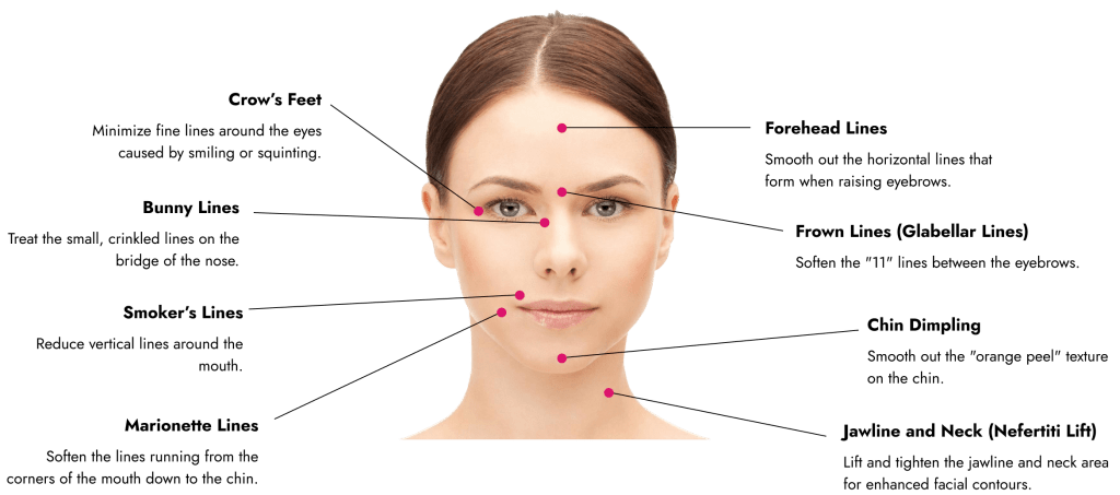 Botox In Geneva,IL ER wellness target areas image for botox treatment