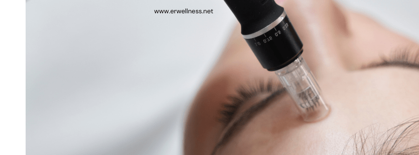 Does Microneedling Really Work? Nurse Practitioner Emily Weighs In