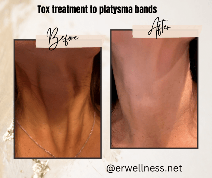 A before-and-after image of a person's neck, showing the reduction of prominent platysma bands after a neurotoxin treatment.