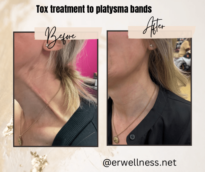 A before-and-after image of the same woman's neck from a different angle, showcasing the comprehensive results of a neurotoxin treatment for platysma bands.