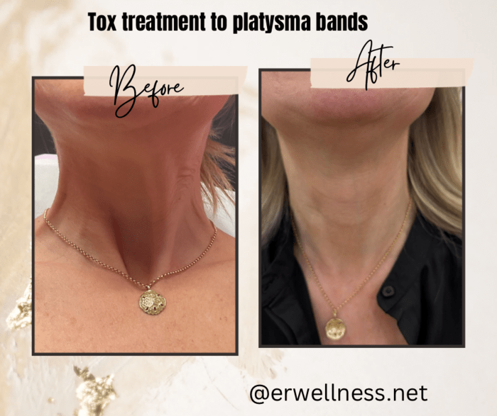 This image presents a before-and-after comparison of a patient's neck, highlighting the reduction of platysma bands after treatment at ER Wellness in Geneva, IL. The visual demonstrates the successful smoothing of the neck area, providing a more youthful and refined contour. This visual is an effective marketing tool for ER Wellness to showcase its expertise and the tangible results of its neck rejuvenation services.