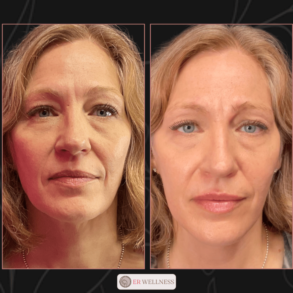 RF-Microneedling-Results before and after