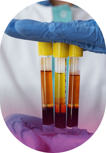 EZ Gel PRF-Based Filler for Natural Anti-Aging Results EZ Gel Fillers