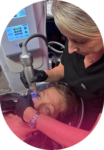 RF Microneedling for Smooth, Youthful Skin RF Microneedling