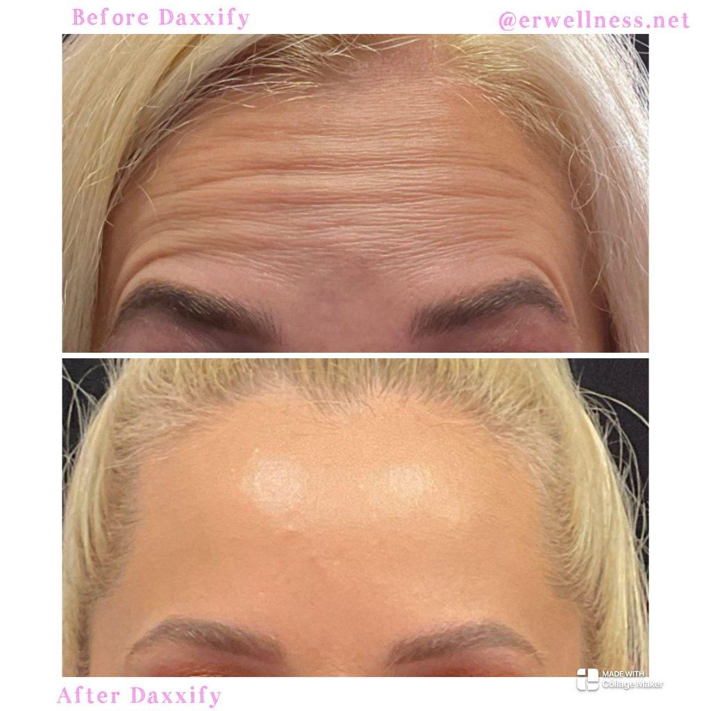 Before and after Client Images Daxxify treatment forehead