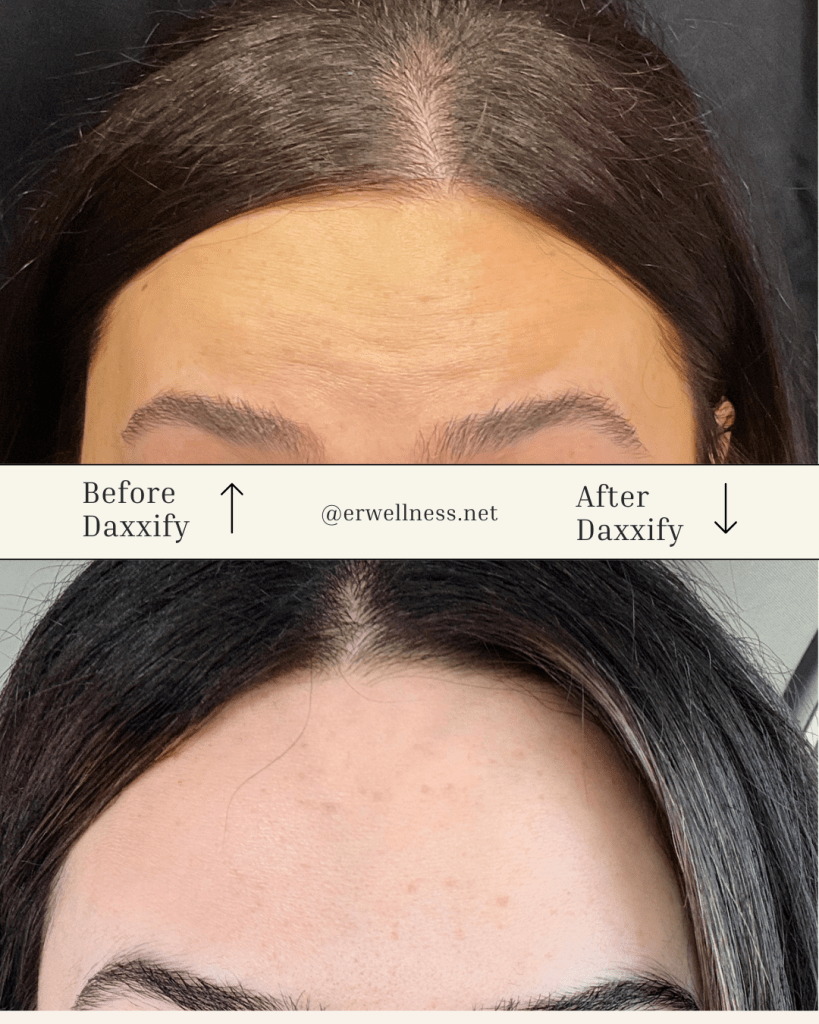 Before and after Client Images Daxxify treatment forehead 2