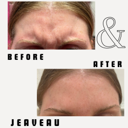 Jeuveau forehead before and after results at ER Wellness showing smoother, wrinkle-free skin 2