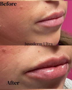 Lip filler before and after results at ER Wellness showing fuller, natural-looking lips