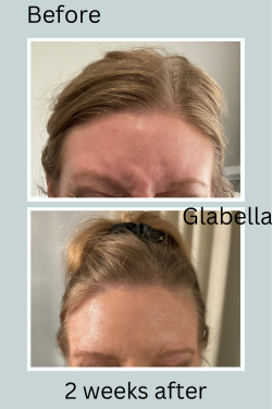 Before and after results of a client at ER Wellness showing visible improvements