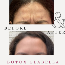 Botox glabella before and after results at ER Wellness showing smoother forehead and reduced frown lines